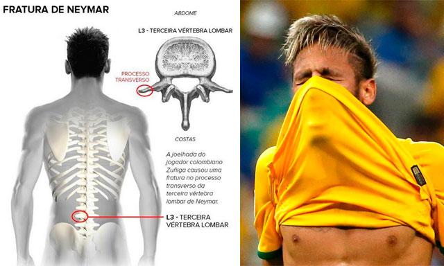 Fractura neymar