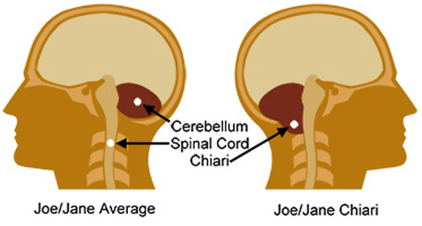 ¿Qué es la malformación de Chiari?