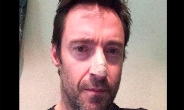 Hugh Jackman es diagnosticado con cáncer de piel