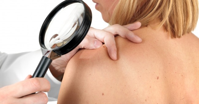 Nuevo fármaco contra melanoma despierta esperanzas entre expertos en cáncer