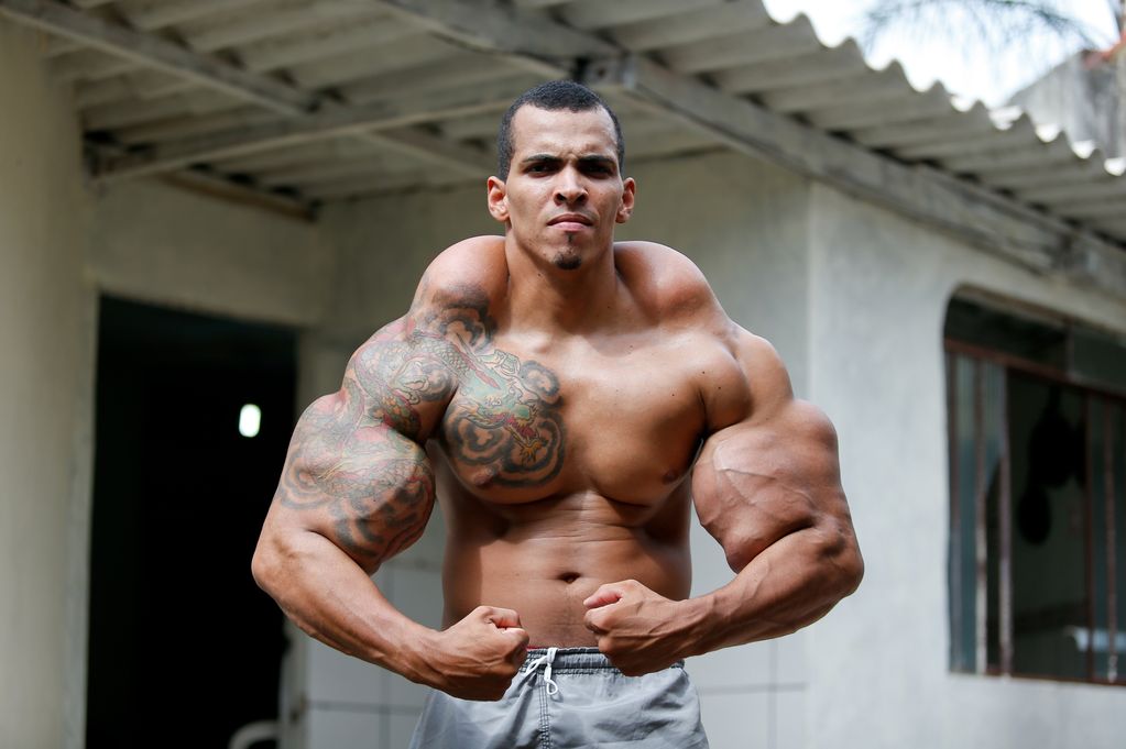 El “Hulk” humano casi pierde los brazos por inyectarse aceite (Fotos)