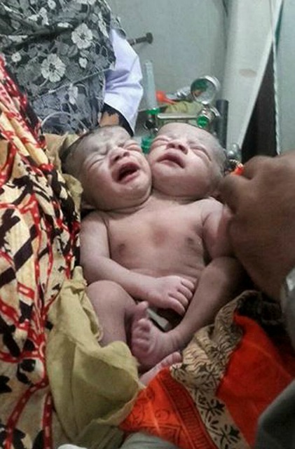 Una niña de Bangladesh nacido con dos cabezas recibe atención médica en un hospital de Brahmanbaria, a unos 120 kms al este de la capital Dhaka el 12 de noviembre de 2015. Los médicos de un hospital de Bangladesh estaban tratando a una niña que nació con dos cabezas, funcionarios médicos y los de recién nacidos padre dijo. El bebé nació a finales 11 de noviembre 2015 y ahora está siendo tratado por problemas respiratorios después de ser trasladado a la unidad de cuidados intensivos del hospital más grande del país en Dhaka. AFP PHOTO