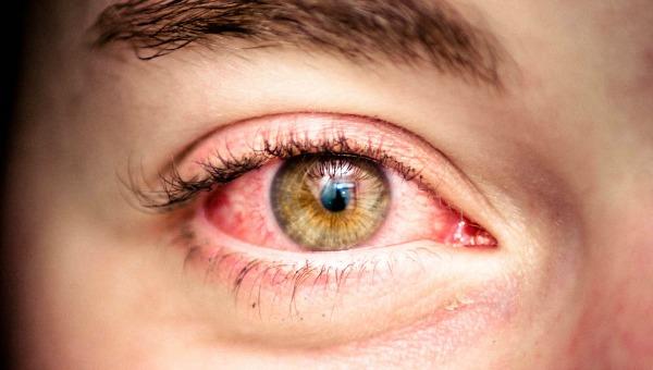 ¿Le ha pasado? Conozca la razón por la que los ojos se ponen rojos al salir de una piscina