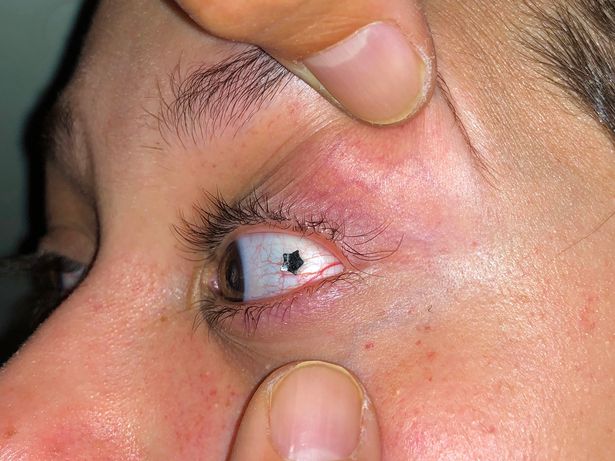 ¿WTF? Se insertó una joya de platino dentro de ojo por moda