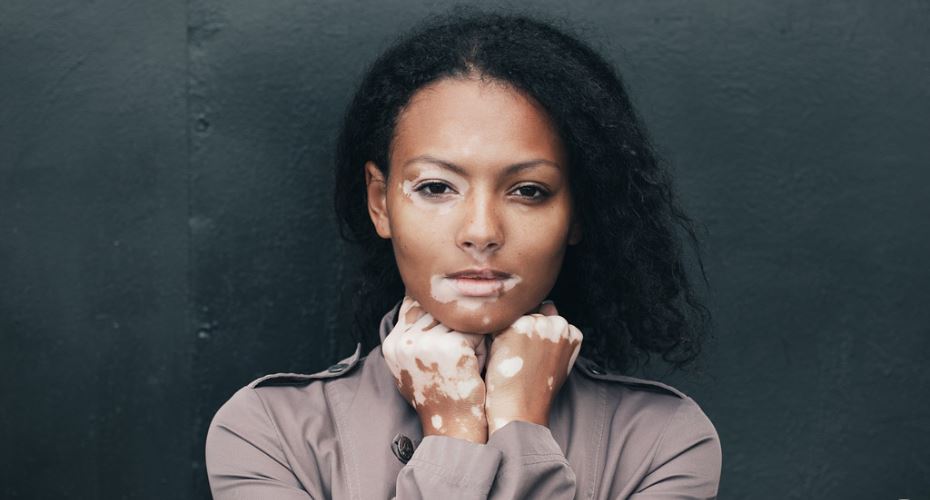 ¡Una solución para el vitiligo! La micropigmentación semipermanete