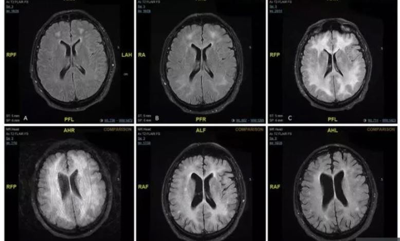 Revelan imágenes contundentes de cómo la cocaína devora el cerebro de un adicto