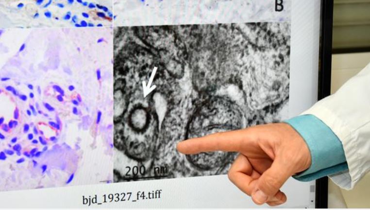 Investigadores españoles demuestran la presencia de coronavirus en lesiones de la piel