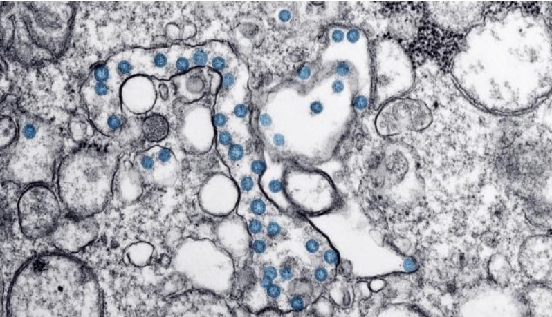 El coronavirus no infecta el cerebro pero puede infligir importantes daños, según estudio