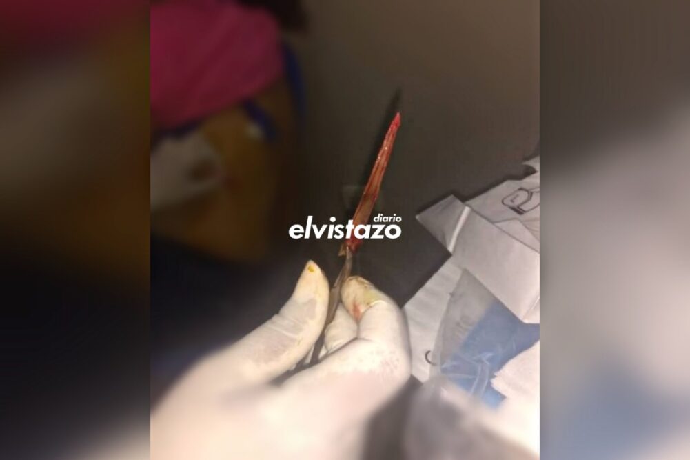 Joven fue agredida por su cuñada en Anzoátegui con un aguijón de raya (FOTO)