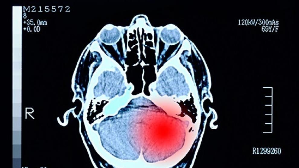 Descubren un mecanismo que podría convertirse en un nuevo tratamiento contra el cáncer