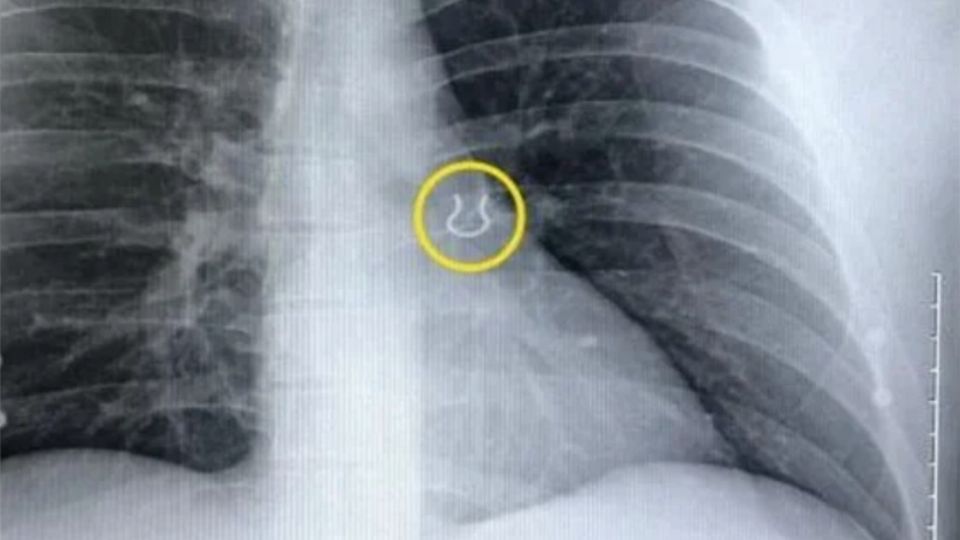 Pensó que tenía neumonía y le encontraron el piercing que perdió hace cinco años en sus pulmones