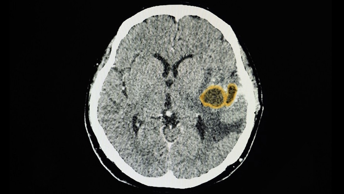 Peligro en EEUU: Aumento inexplicable de una rara infección cerebral en niños