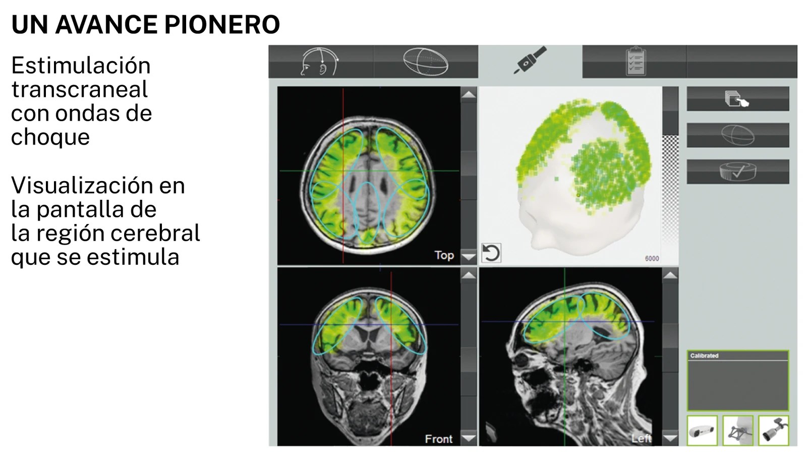 Estimulación con ondas de choque, nueva esperanza frente al Alzheimer