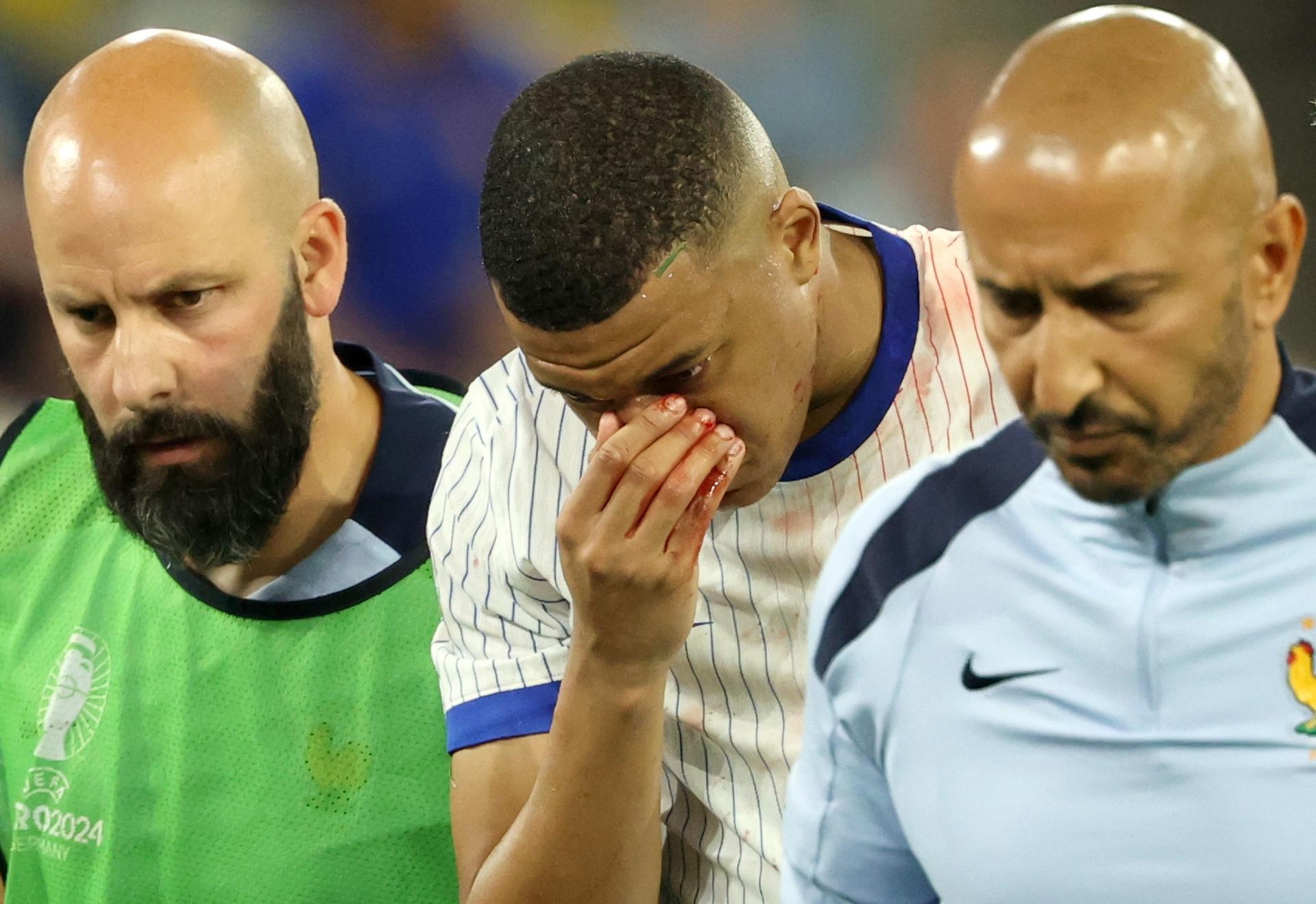 Mbappé no será operado tras sufrir fuerte lesión en la nariz