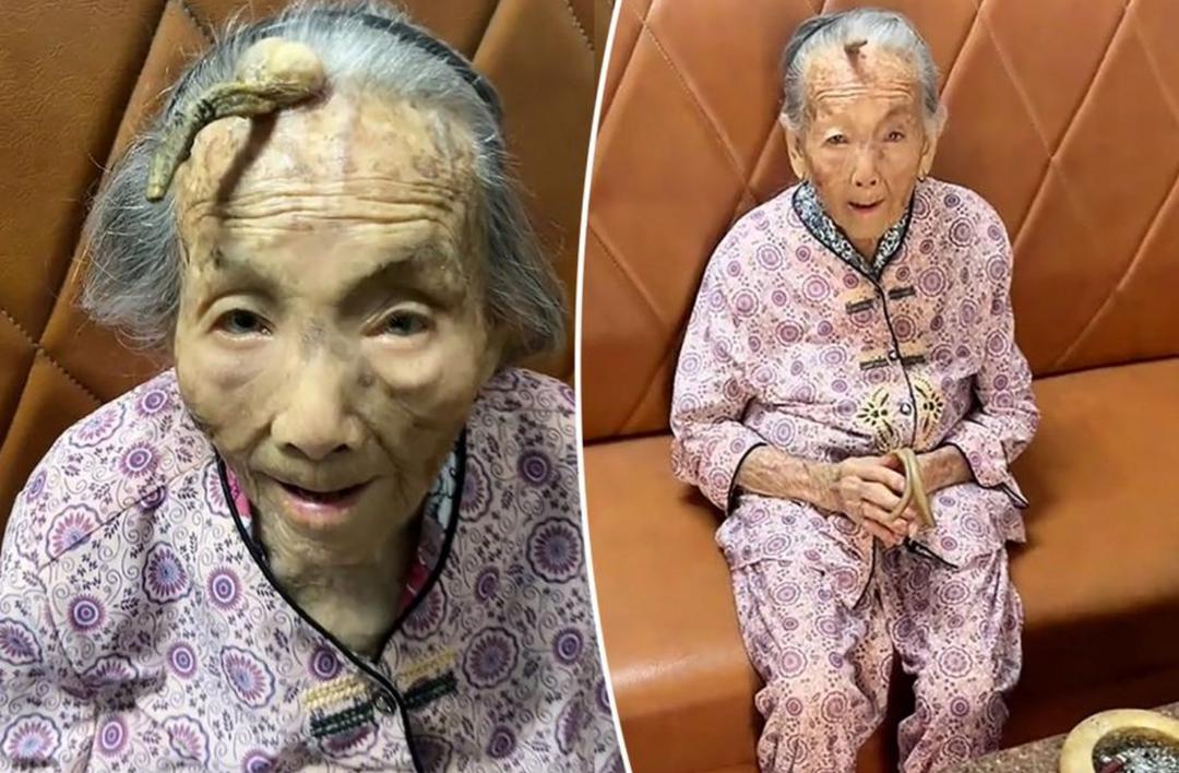 Anciana de 107 años se viralizó en las redes sociales al mostrar el cuerno que lleva en la frente